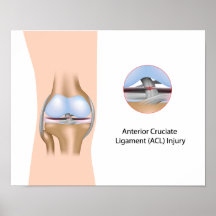 Anterior Cruciate Ligament injury Poster