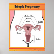 Ectopic Pregnancy Print