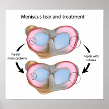 Meniscus tear and surgery  Poster