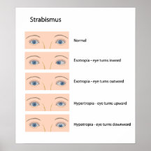 Strabismus eye defect Poster