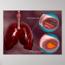 Search for lung posters Medical