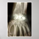Search for xray bones posters Radiology