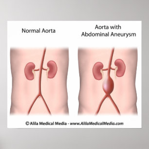 Abdominal Aortic Aneurysm poster