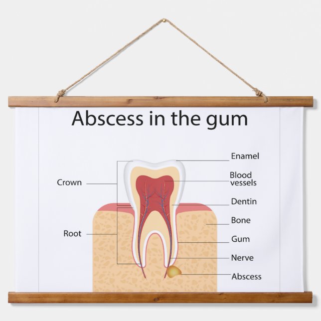 Abscess in the gum hanging tapestry (Front)