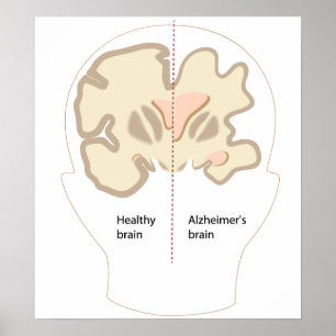 Alzheimer's disease brain Poster