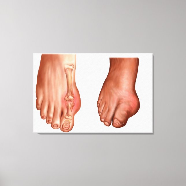 Anatomy Of A Swollen Foot Canvas Print (Front)