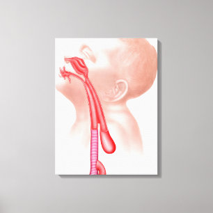 Anatomy Of A Tracheoesophageal Fistula Canvas Print