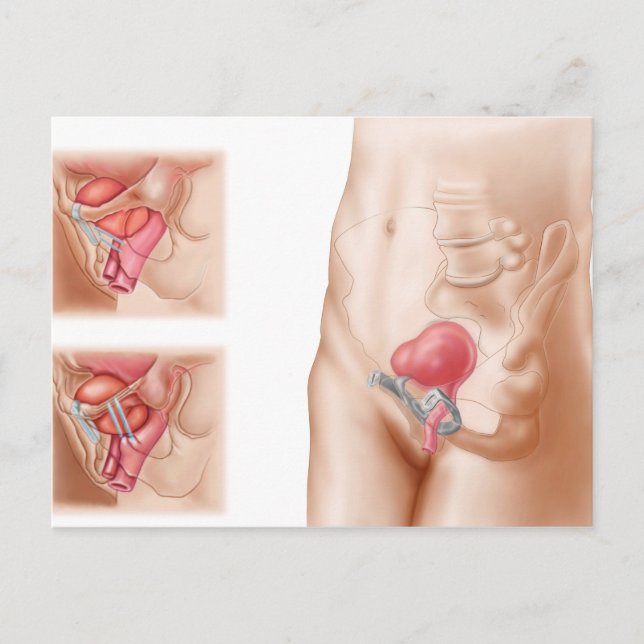 Anatomy Of Bladder Suspension Procedure Postcard (Front)