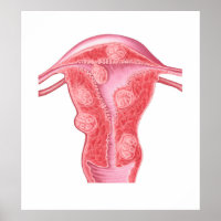 Anatomy Of Fibroid Tumours In Female Uterus