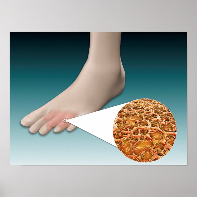 Anatomy Of Foot Fungus With Microscopic Close-Up Poster (Front)