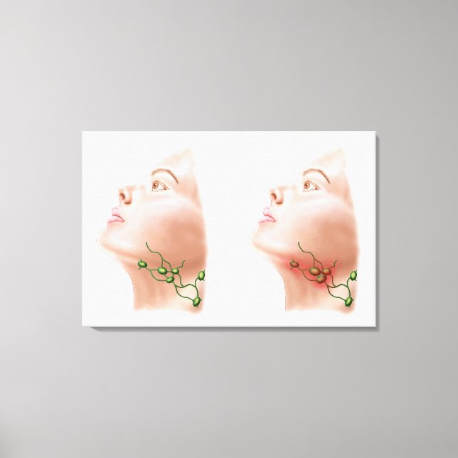 Anatomy Of Swollen Lymph Nodes Canvas Print (Front)