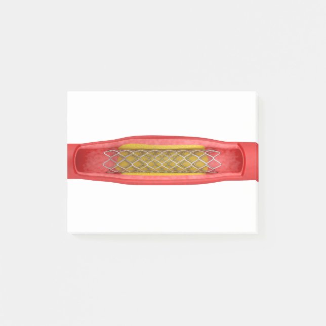 Angioplasty with stent placement post-it notes (Front)