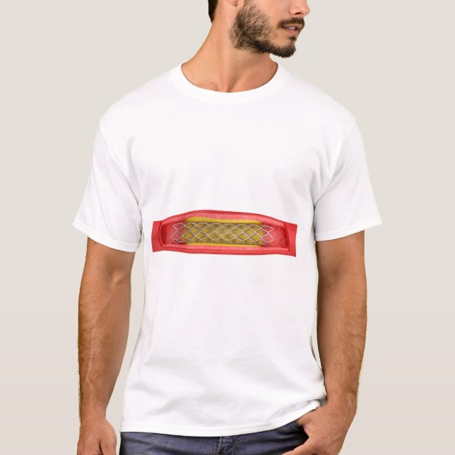 Angioplasty with stent placement T-Shirt (Front)
