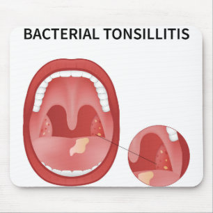 Bacterial tonsillitis mouse pad