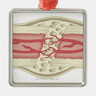 Bone Repairing Itself 2 Metal Tree Decoration