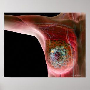 Breast cancer 2 poster