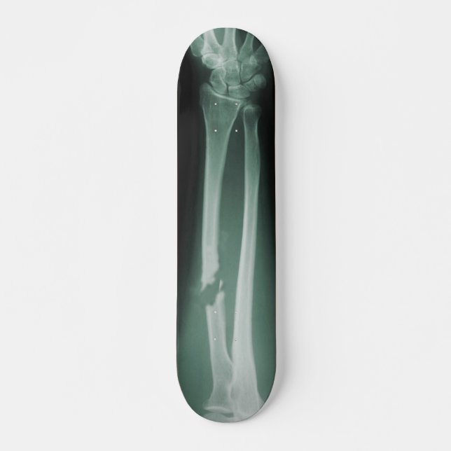 Broken Bones Skateboard (Front)