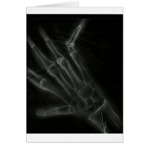 Broken Hand X-ray