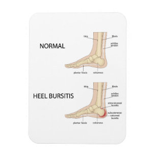 Calcaneal bursitis magnet