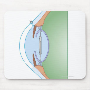 Cataract Surgery Mouse Pad