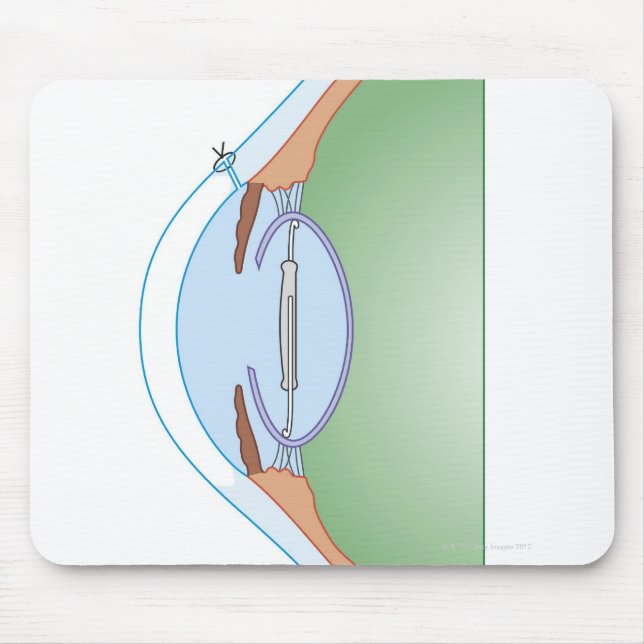 Cataract Surgery Mouse Pad (Front)