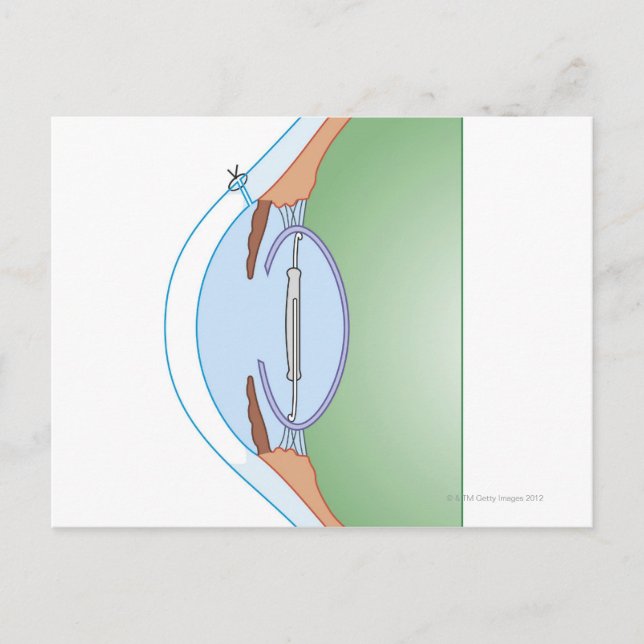 Cataract Surgery Postcard (Front)