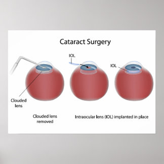 Cataract surgery  Poster