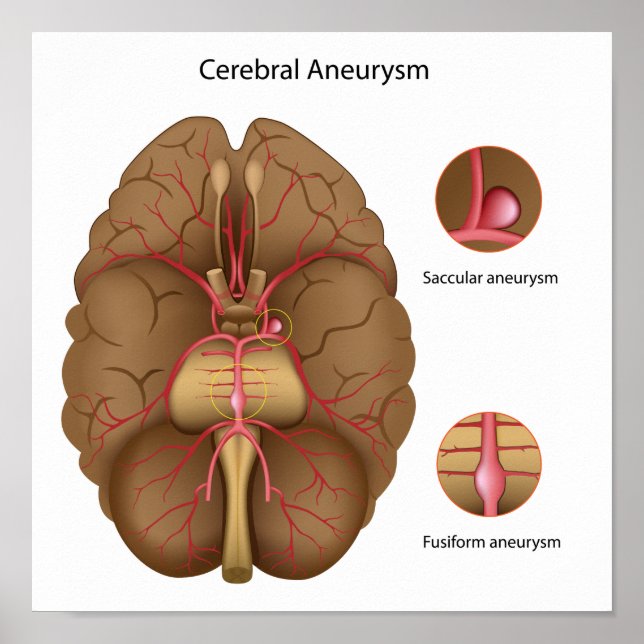 Cerebral aneurysm Poster (Front)