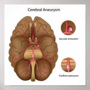 Cerebral aneurysm Poster