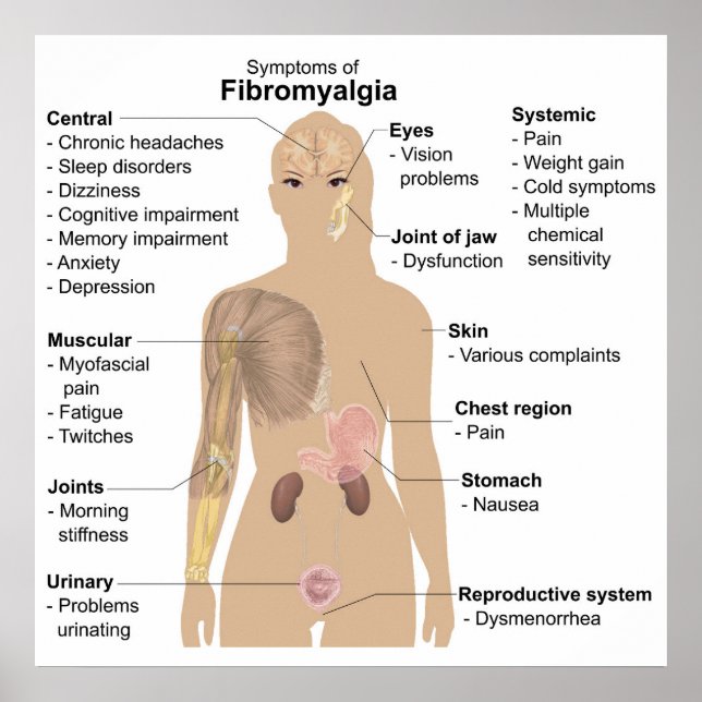 Chart Common Signs + Symptoms Fibromyalgia Poster (Front)