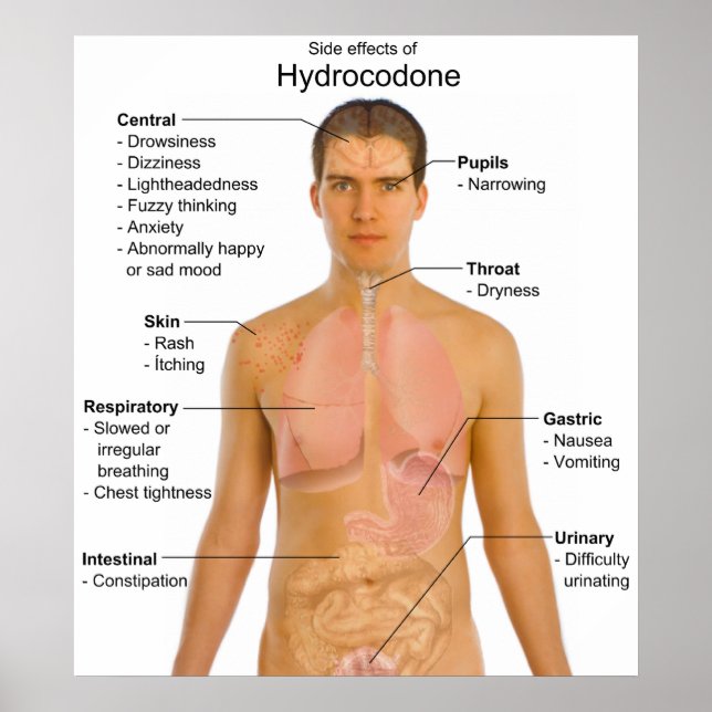 Chart of the Side Effects of Opioid Hydrocodone (Front)