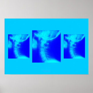 Chiropractic Poster: Lateral Cervical Blues Poster
