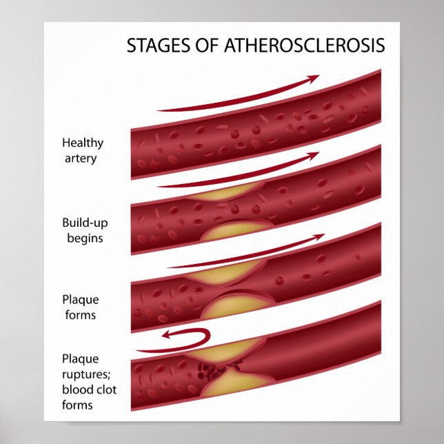 Cholesterol plaque stages Poster (Front)