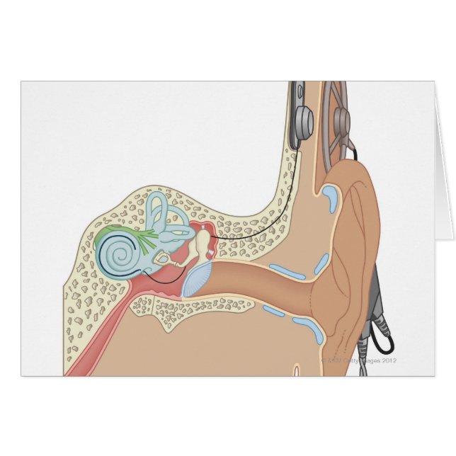 Cochlear Implants (Front Horizontal)