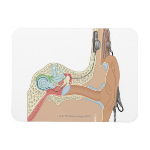 Cochlear Implants Magnet