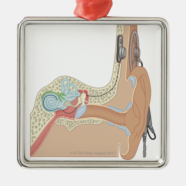 Cochlear Implants Metal Tree Decoration (Front)