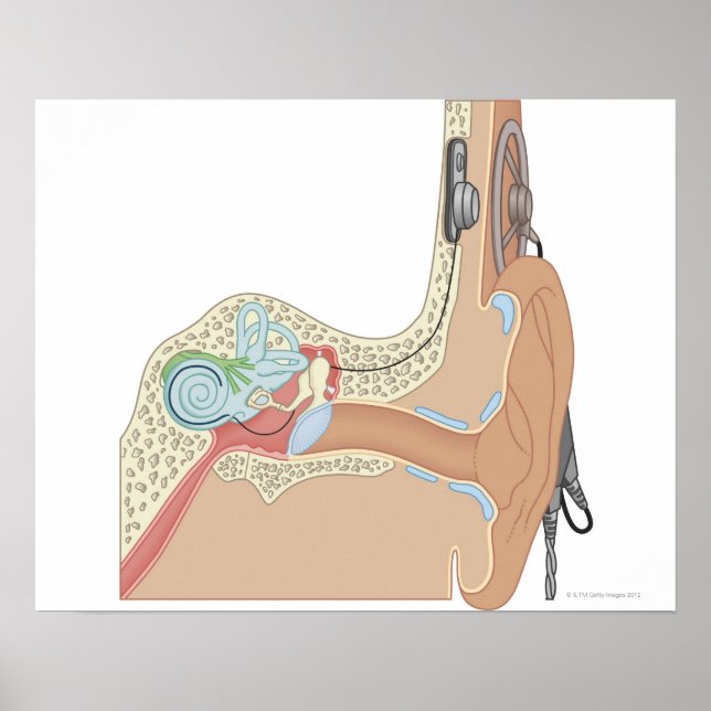 Cochlear Implants Poster (Front)