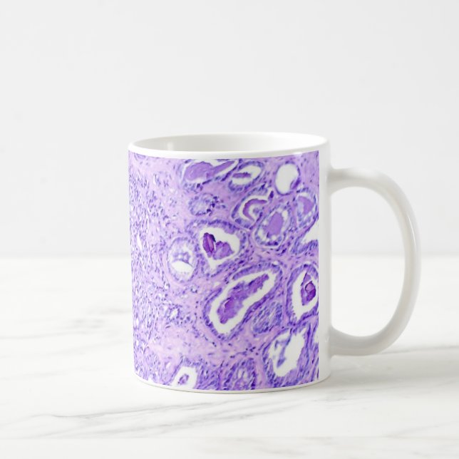 Coffee Mug-Prostate Cancer Mug (Right)