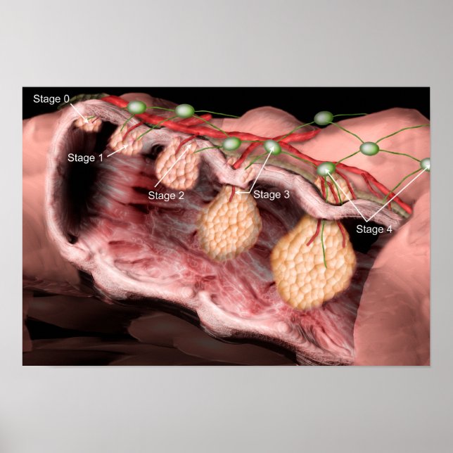 Colon cancer poster (Front)