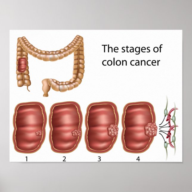 Colon cancer progression Poster (Front)