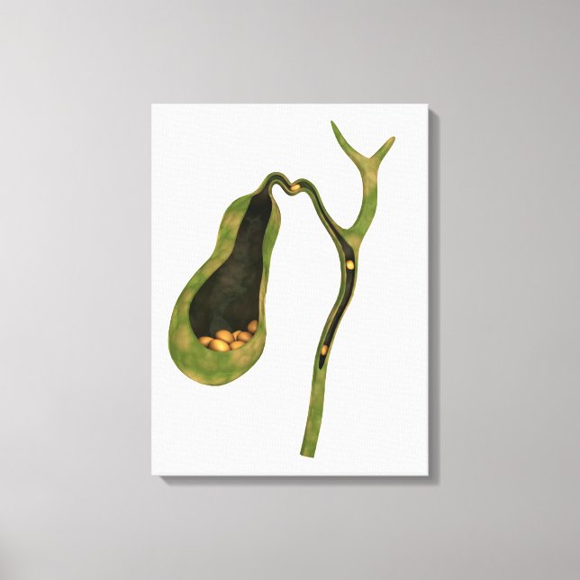 Conceptual Image Of Gallstones Inside Gall Canvas Print (Front)