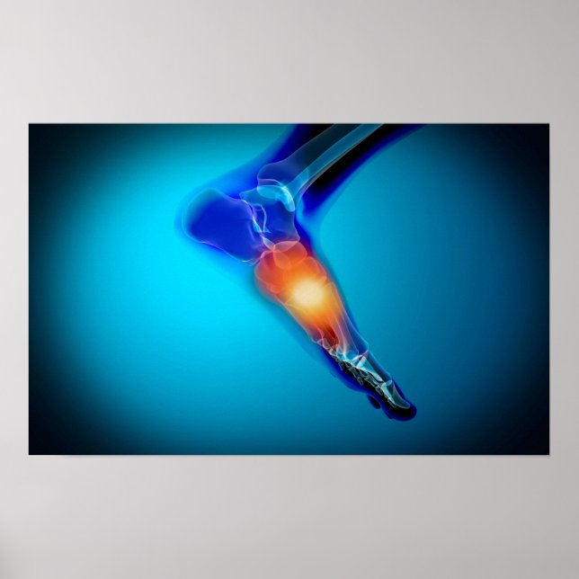 Conceptual Image Of Pain In Human Foot Poster (Front)