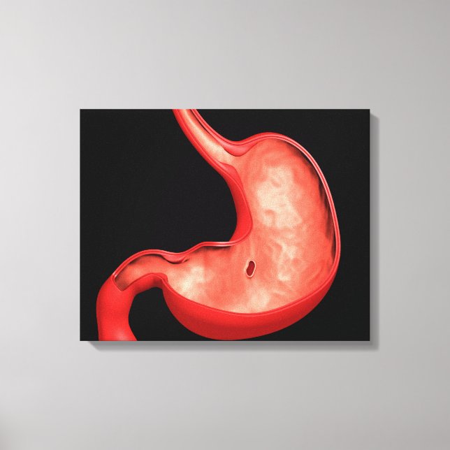 Conceptual Image Of Peptic Ulcer In Stomach Canvas Print (Front)