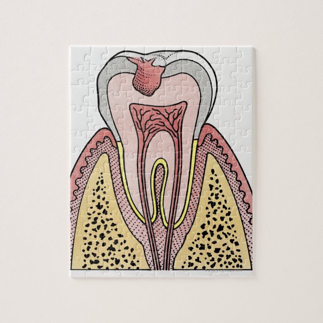 Cross section illustration showing tooth decay jigsaw puzzle (Vertical)