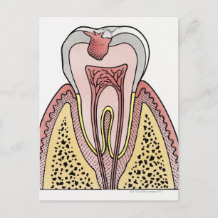 Cross section illustration showing tooth decay postcard