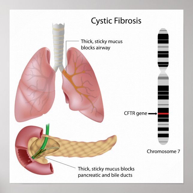 Cystic fibrosis Poster (Front)