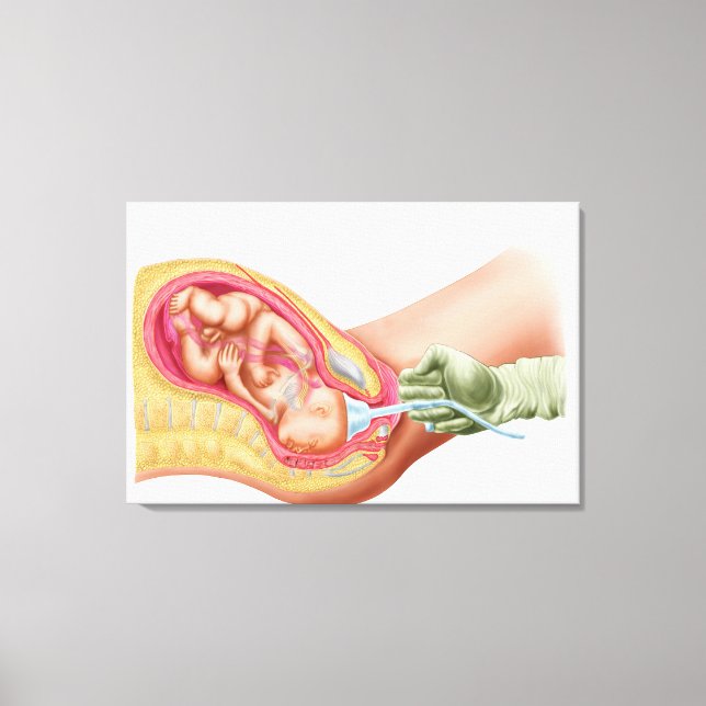 Delivery Of Foetus Using Vacuum Extraction Canvas Print (Front)