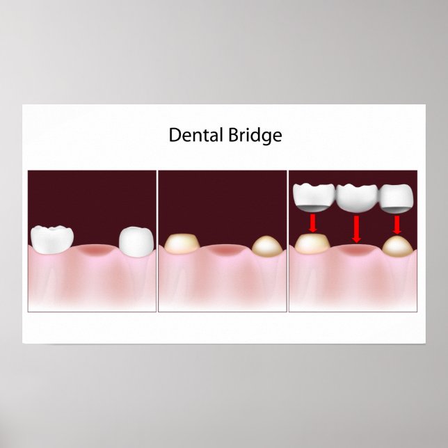 Dental bridge procedure Poster (Front)