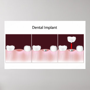 Dental implant procedure Poster