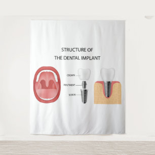 Dental implant structure tapestry